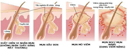 Điều trị mụn ở đâu uy tín và hiệu quả?